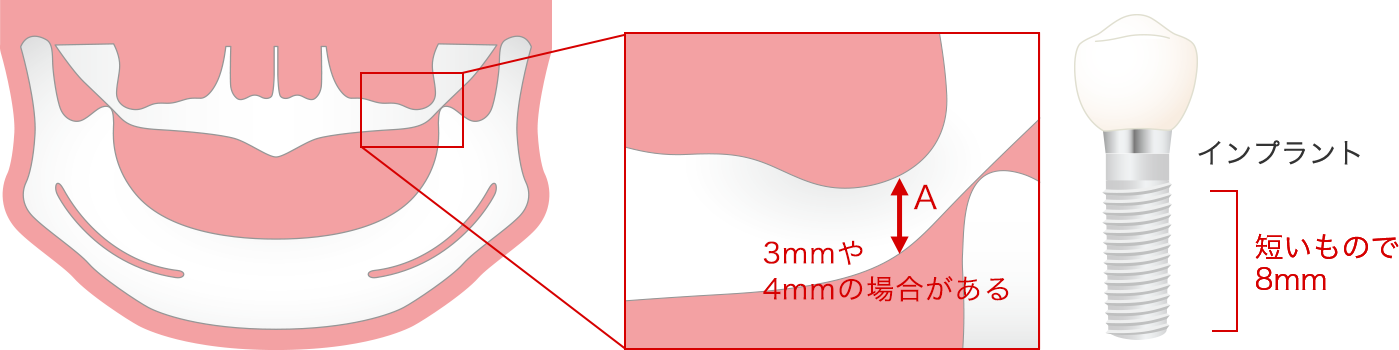 上顎洞の幅