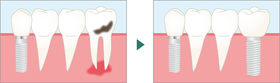 インプラント治療の前後