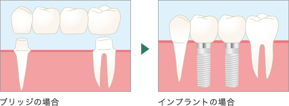 ブリッジとインプラントの比較