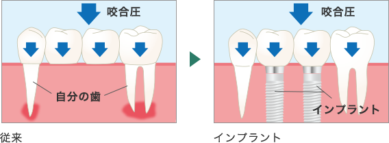 インプラントと噛む力の関係