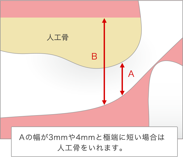 サイナスリフト