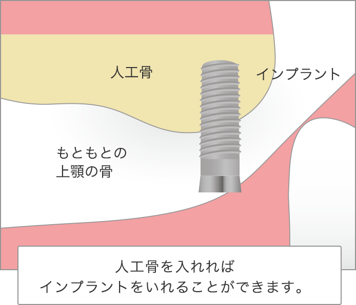 インプラント埋入