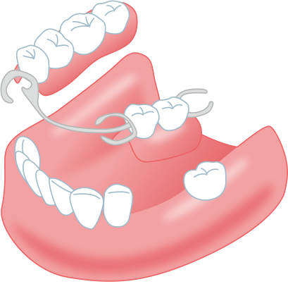 歯を失ってしまった方 またはインプラントと入れ歯とブリッジで悩んでいる方へ やまもと歯科インプラント室