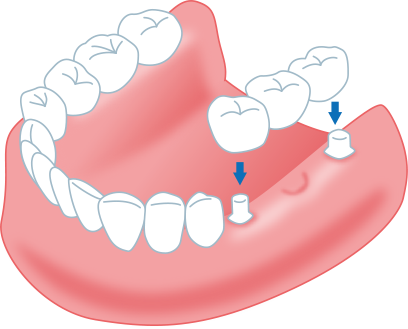 歯を失ってしまった方 またはインプラントと入れ歯とブリッジで悩んでいる方へ やまもと歯科インプラント室