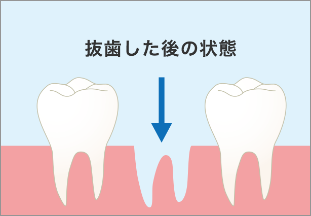 抜歯した後の状態