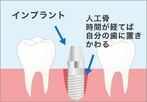 抜歯後に人工骨で埋める