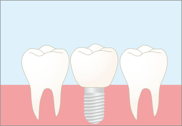 インプラントの完成